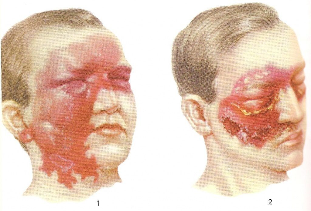 Рожистое воспаление лица
